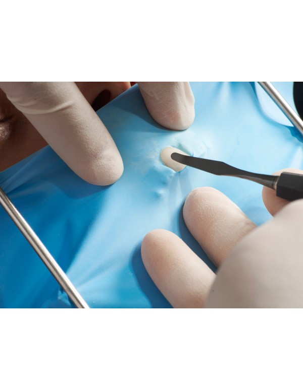 Espátula para facetas em compósito MV3X – Dr Monik Vasant