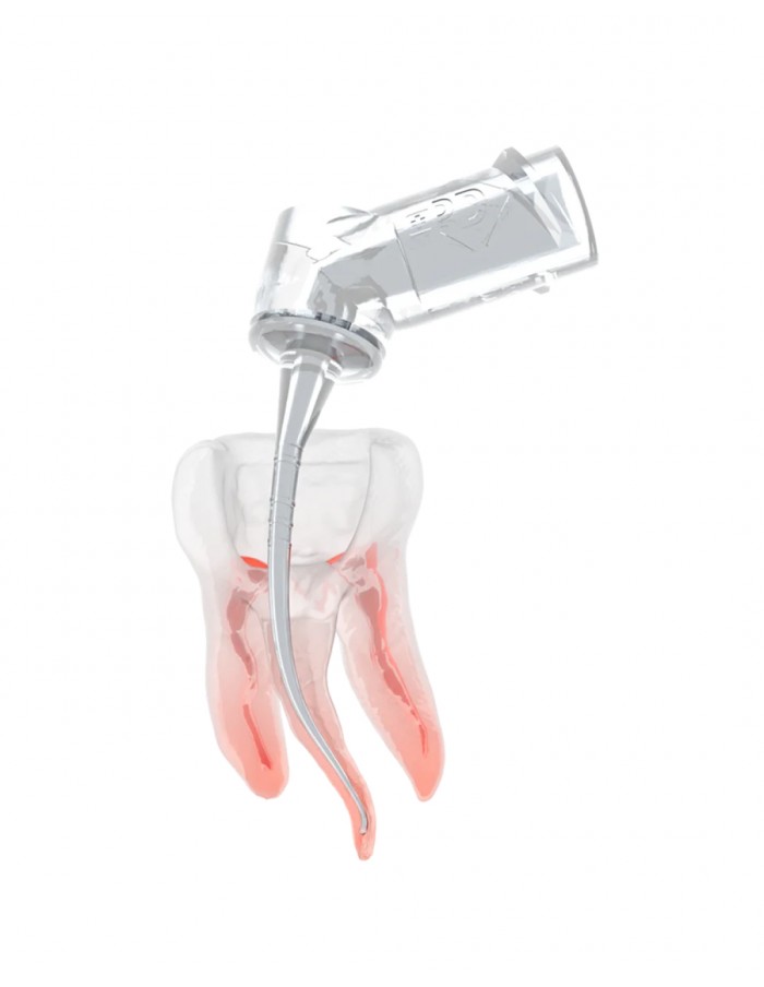 A IrriFlex® adapta-se facilmente a anatomias complexas dos canais radiculares. A IrriFlex® adapta-se facilmente a anatomias complexas dos canais radiculares.