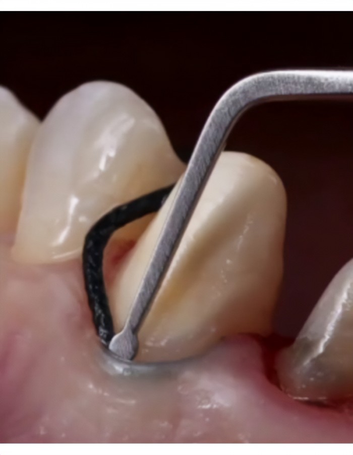 Empacotador de fio retrator gengival pequeno NM4.